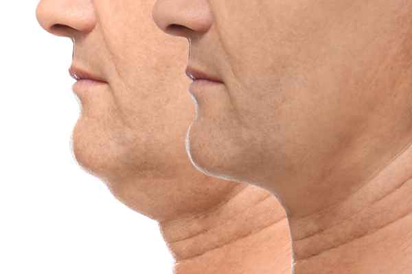 HIFU - Breakthrough in Anti - ageing 2 hifu results Sandwich
