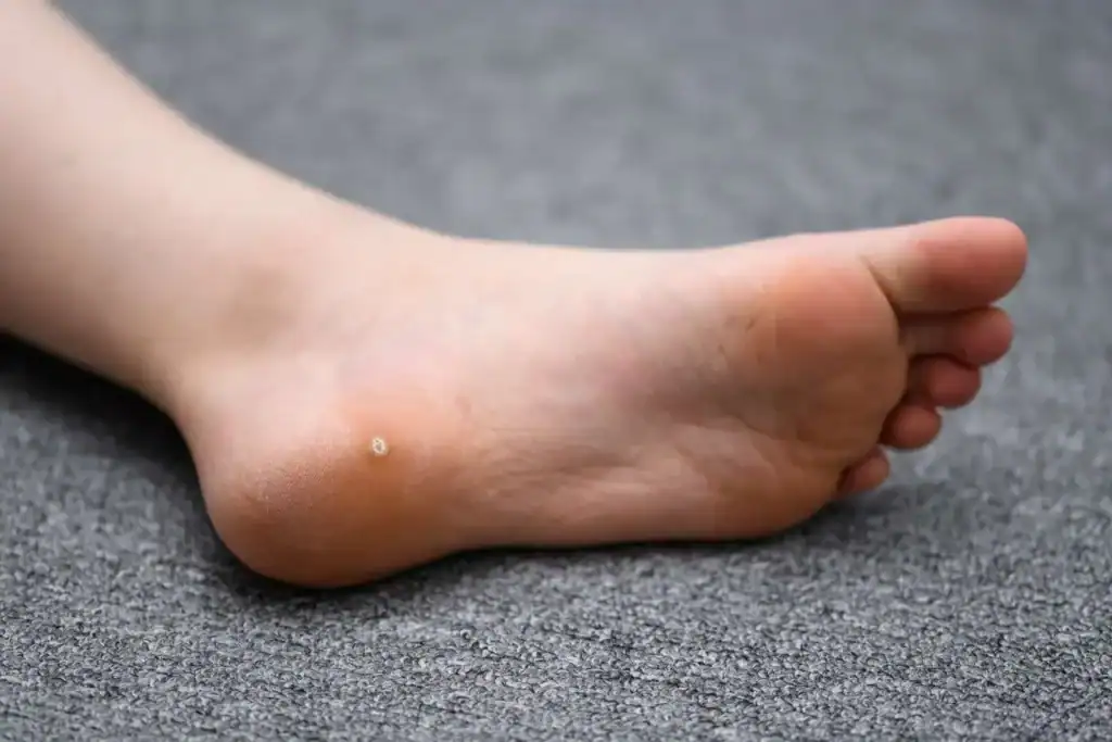 Cryotherapy For Warts And Also Verrucas 2 Image of verruca on the bottom of the foot that able to be treated with Cryotherapy Sandwich