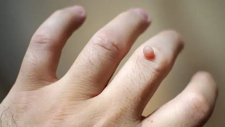 Image of blemish that Cryotherapy Sandwich can remove with Lipo 360.