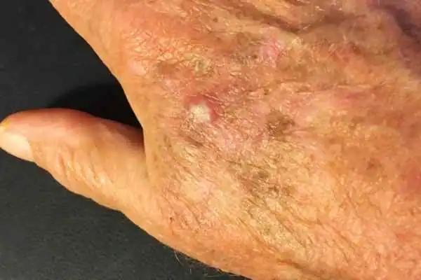 Cryopen For Actinic Keratoses 1 Image of Actinic keratoses Sandwich on a person hand