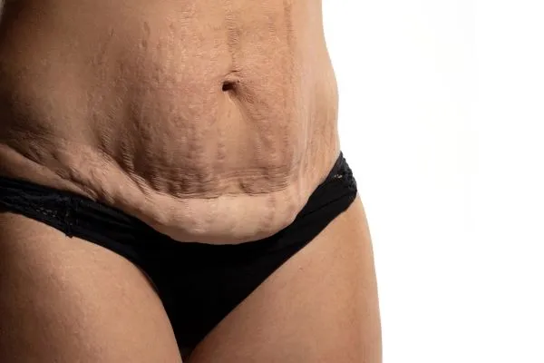 The Science of Skin Tightening 1 The science behind skin tightening Sandwich picture of a woman's sagging skin on the stomach